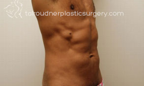 Liposuction