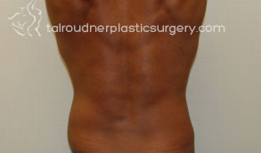 Liposuction