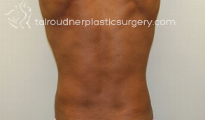 Liposuction
