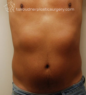 Liposuction