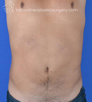 Liposuction