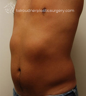 Liposuction