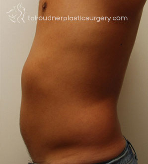 Liposuction