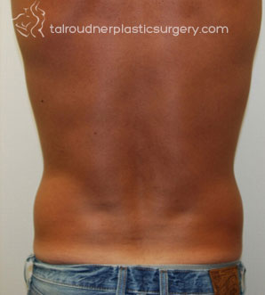 Liposuction