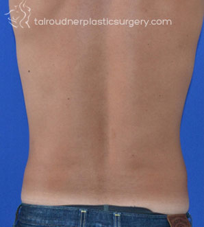 Liposuction