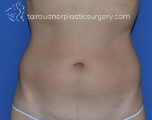 Liposuction