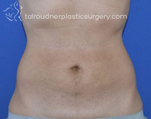 Liposuction