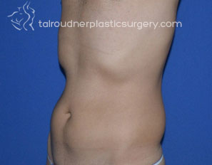 Liposuction