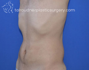 Liposuction