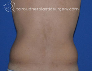 Liposuction