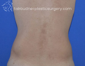 Liposuction