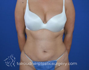 Tummy Tuck