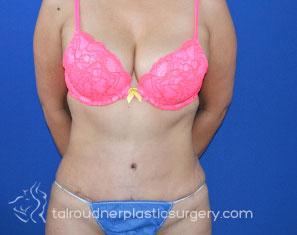 Tummy Tuck