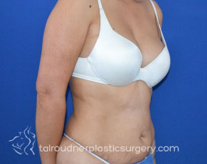 Tummy Tuck