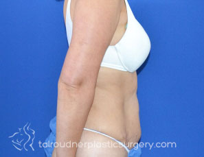 Tummy Tuck