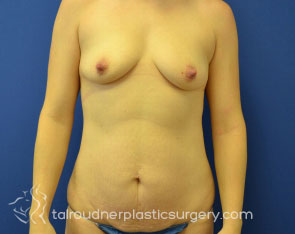 Tummy Tuck