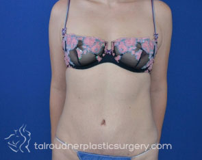 Tummy Tuck