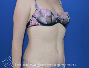 Tummy Tuck