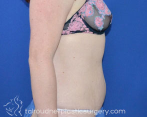 Tummy Tuck