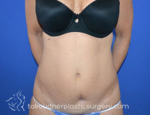 Tummy Tuck