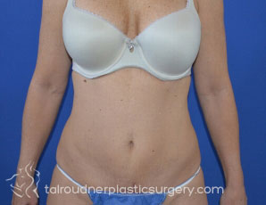 Tummy Tuck