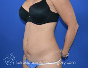 Tummy Tuck