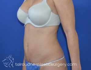 Tummy Tuck