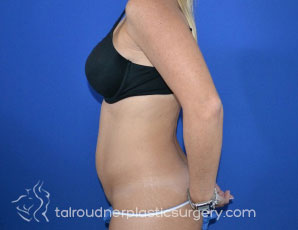 Tummy Tuck
