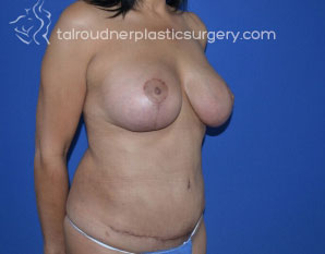 Tummy Tuck