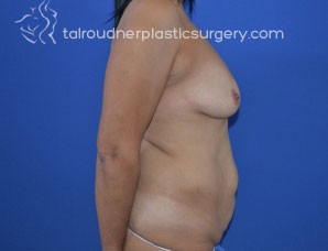 Tummy Tuck