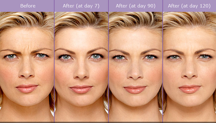Miami Botox Before & After Miami Botox Before & After