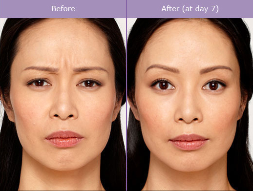 Miami Botox Before & After Miami Botox Before & After