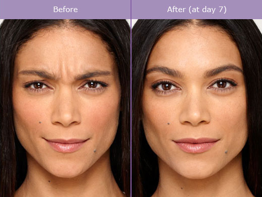 Miami Botox Before & After Miami Botox Before & After