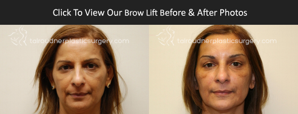 Miami Brow Lift / Forehead Lift Before & After Photo Miami Brow Lift / Forehead Lift Before & After Photo