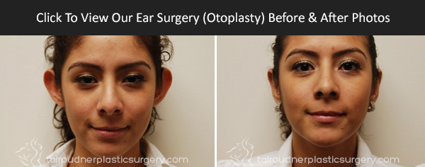 Miami Ear Surgery (Otoplasty) Before & After Photo Gallery Miami Ear Surgery (Otoplasty) Before & After Photo Gallery