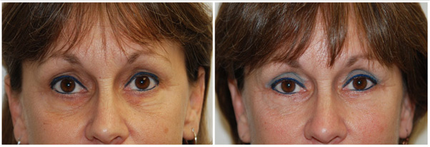 Miami Eyelid Surgery (Blepharoplasty) Before & After Photo Gallery Miami Eyelid Surgery (Blepharoplasty) Before & After Photo Gallery
