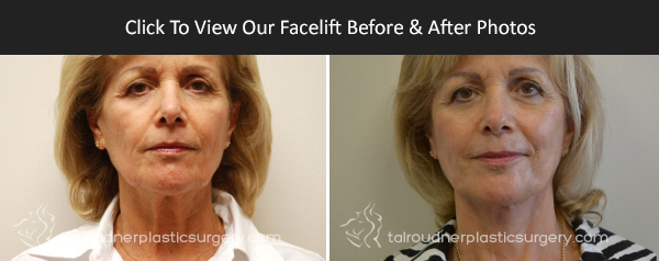 Miami Facelift Before & After Photo Gallery Miami Facelift Before & After Photo Gallery