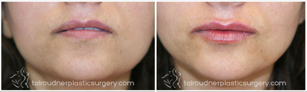 Miami Lip Augmentation Before & After Photo Gallery Miami Lip Augmentation Before & After Photo Gallery