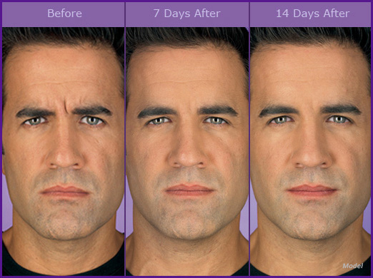 Miami Male Botox Before & After Photo