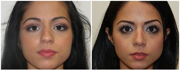 Miami Nose Surgery (Rhinoplasty) Before & After Photo Miami Nose Surgery (Rhinoplasty) Before & After Photo