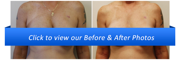 Miami Breast Reconstruction Before & After Photo Miami Breast Reconstruction Before & After Photo