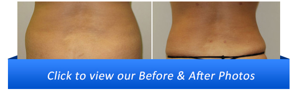 Miami Liposuction Before & After Photo Gallery Miami Liposuction Before & After Photo Gallery