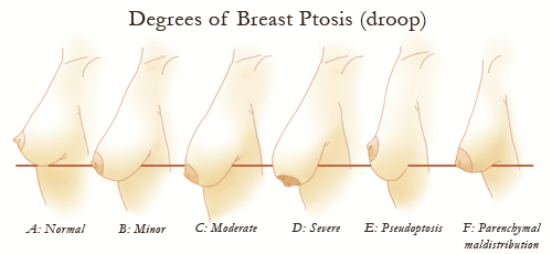 Moderately to Severely Drooping Breasts