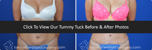 Tummy Tuck Before & After: (Abdominoplasty) Tummy Tuck Surgery by Dr. Tal Roudner