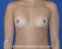 Breast Augmentation