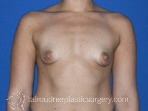 Breast Lift