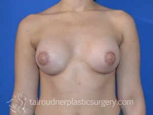Breast Lift