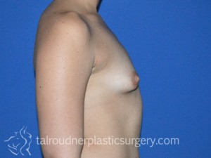 Breast Lift