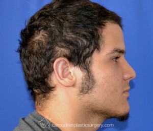 Ear Surgery (Otoplasty)