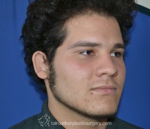 Ear Surgery (Otoplasty)